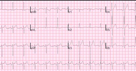 lvh with repolarization abnormality ekg.